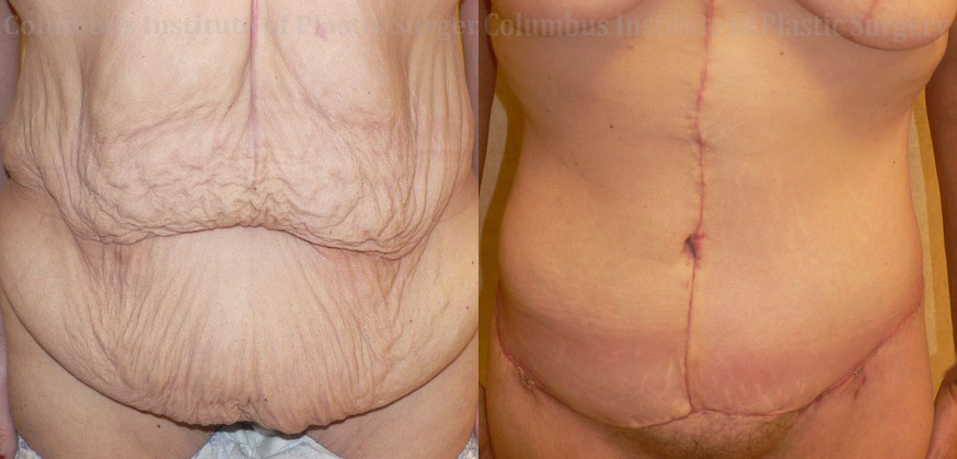 Abdominoplasty after Weight Loss before and after photo by Columbus Institute of Plastic Surgery in Columbus, OH