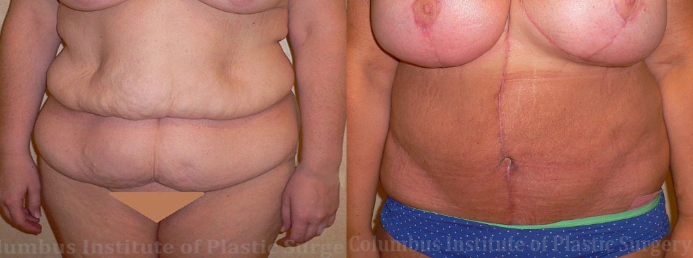Belt Lipectomy before and after photo by Columbus Institute of Plastic Surgery in Columbus, OH