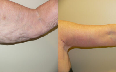 Brachioplasty (Arm Lift) before and after photo by Columbus Institute of Plastic Surgery in Columbus, OH Brachioplasty (Arm Lift) before and after photo by Columbus Institute of Plastic Surgery in Columbus, OH