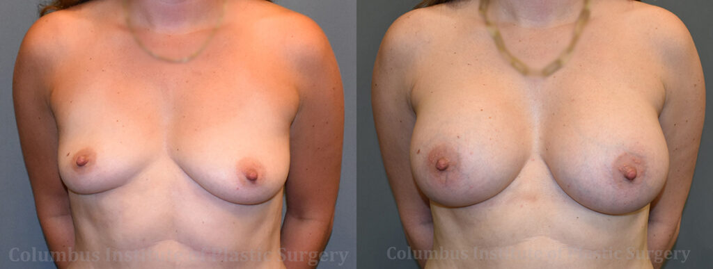 Breast Augmentation – 400cc-500cc before and after photo by Columbus Institute of Plastic Surgery in Columbus, OH