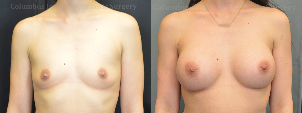 Breast Augmentation before and after photo by Columbus Institute of Plastic Surgery in Columbus, OH