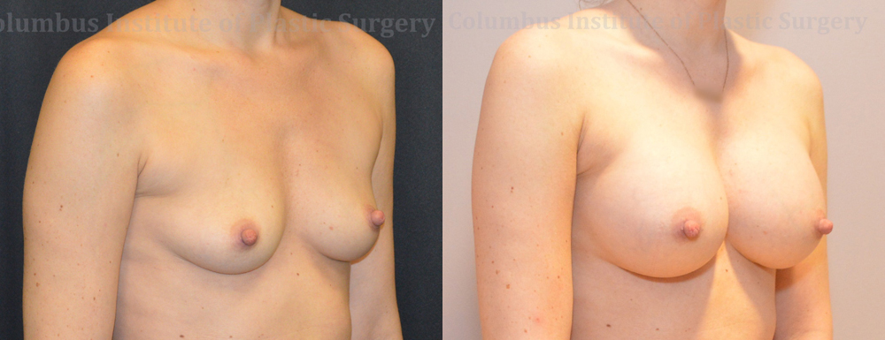 Breast Augmentation before and after photo by Columbus Institute of Plastic Surgery in Columbus, OH