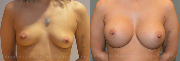 Breast Augmentation before and after photo by Columbus Institute of Plastic Surgery in Columbus, OH