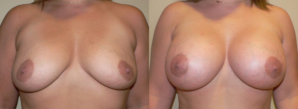 Breast Augmentation before and after photo by Columbus Institute of Plastic Surgery in Columbus, OH