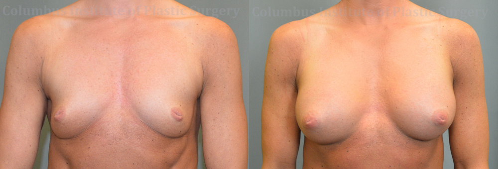 Breast Augmentation before and after photo by Columbus Institute of Plastic Surgery in Columbus, OH