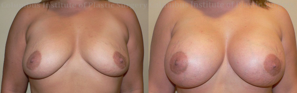 Breast Augmentation before and after photo by Columbus Institute of Plastic Surgery in Columbus, OH