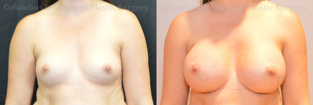 Breast Augmentation before and after photo by Columbus Institute of Plastic Surgery in Columbus, OH