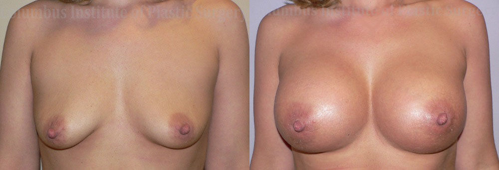 Breast Augmentation before and after photo by Columbus Institute of Plastic Surgery in Columbus, OH