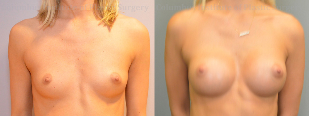 Breast Augmentation before and after photo by Columbus Institute of Plastic Surgery in Columbus, OH