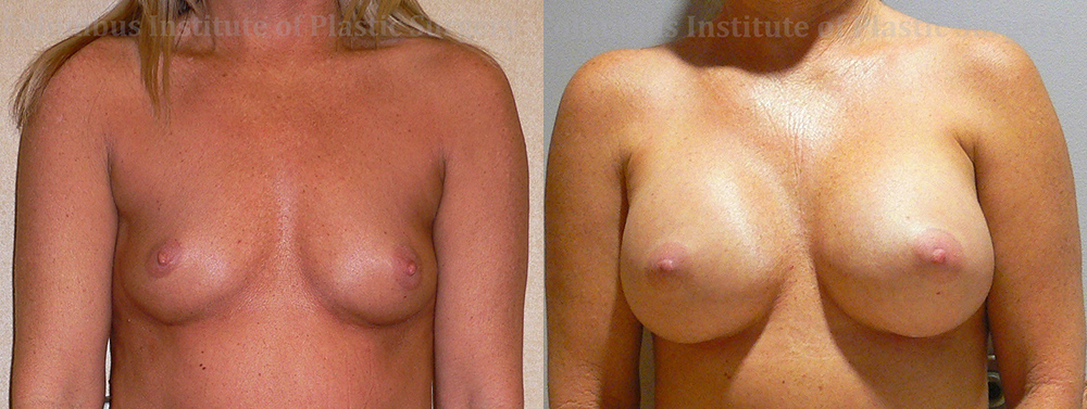 Breast Augmentation before and after photo by Columbus Institute of Plastic Surgery in Columbus, OH