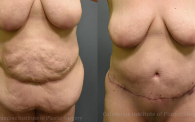 Abdominoplasty (Tummy Tuck) before and after photo by Columbus Institute of Plastic Surgery in Columbus, OH Abdominoplasty (Tummy Tuck) before and after photo by Columbus Institute of Plastic Surgery in Columbus, OH