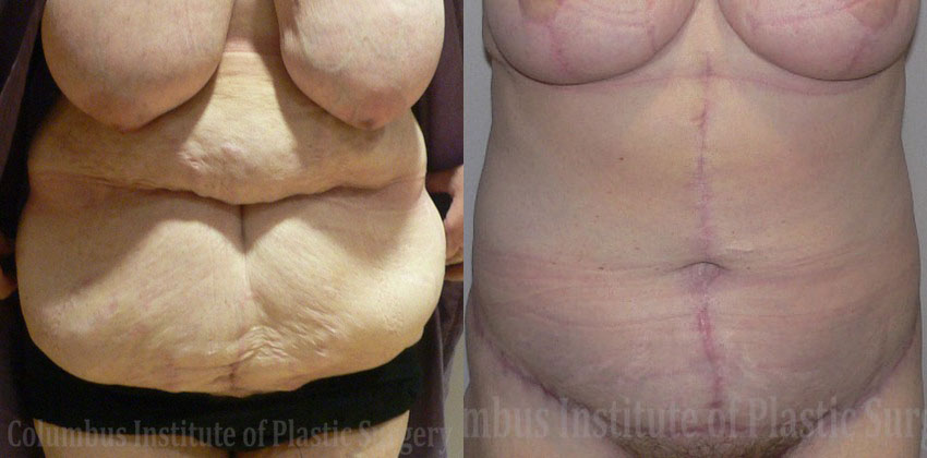 Abdominoplasty after Weight Loss before and after photo by Columbus Institute of Plastic Surgery in Columbus, OH