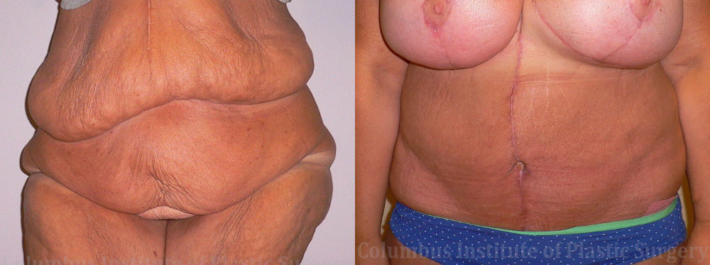 Belt Lipectomy before and after photo by Columbus Institute of Plastic Surgery in Columbus, OH