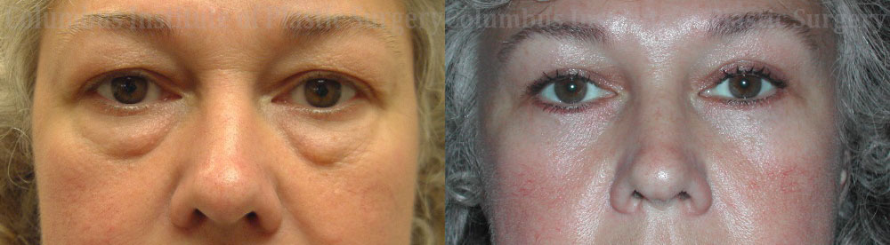 Blepharoplasty before and after photo by Columbus Institute of Plastic Surgery in Columbus, OH