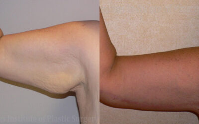 Brachioplasty (Arm Lift) before and after photo by Columbus Institute of Plastic Surgery in Columbus, OH Brachioplasty (Arm Lift) before and after photo by Columbus Institute of Plastic Surgery in Columbus, OH
