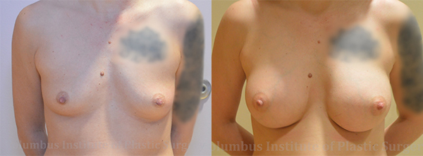 Breast Augmentation – 300cc-400cc before and after photo by Columbus Institute of Plastic Surgery in Columbus, OH