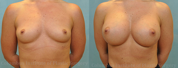 Breast Augmentation – 400cc-500cc before and after photo by Columbus Institute of Plastic Surgery in Columbus, OH