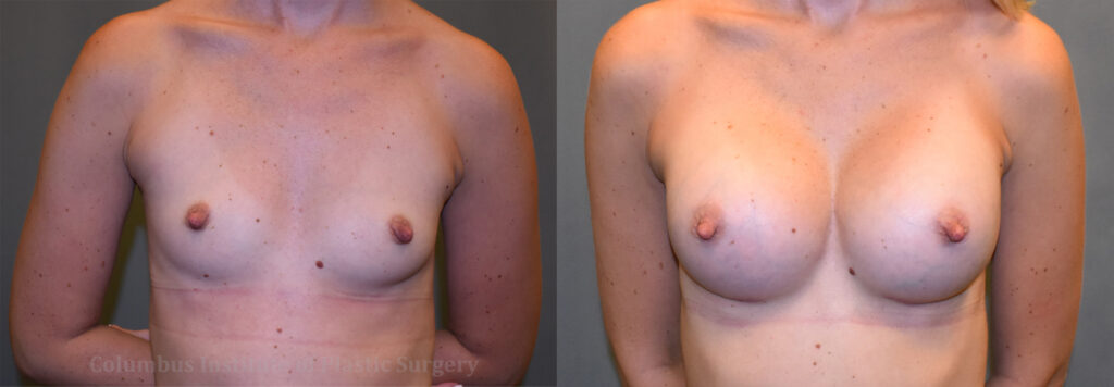 Breast Augmentation before and after photo by Columbus Institute of Plastic Surgery in Columbus, OH