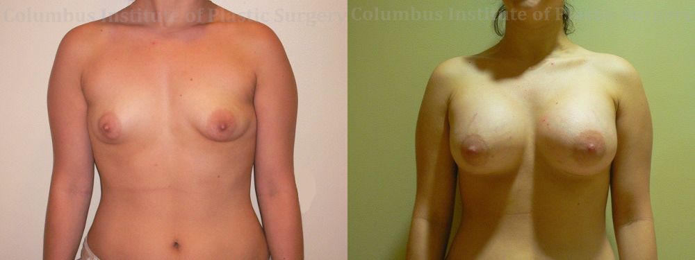 Breast Augmentation before and after photo by Columbus Institute of Plastic Surgery in Columbus, OH