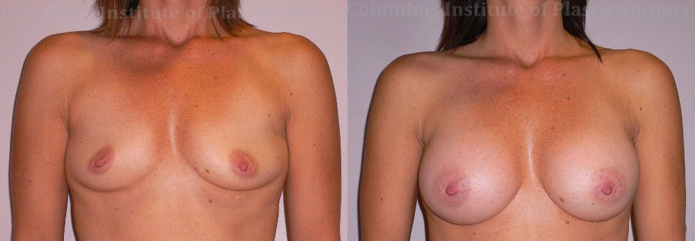 Breast Augmentation before and after photo by Columbus Institute of Plastic Surgery in Columbus, OH