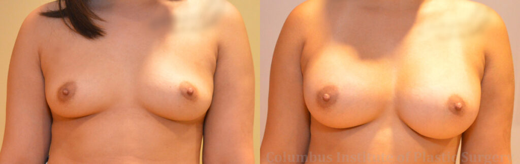Breast Augmentation before and after photo by Columbus Institute of Plastic Surgery in Columbus, OH