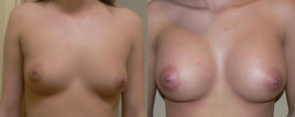 Breast Augmentation before and after photo by Columbus Institute of Plastic Surgery in Columbus, OH