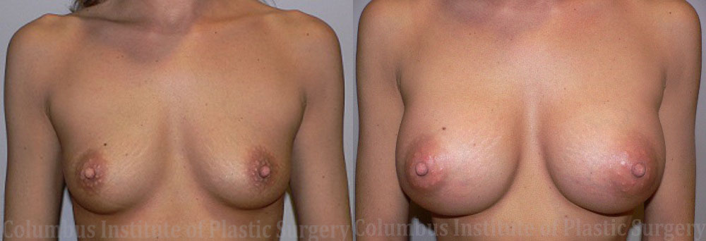 Breast Augmentation before and after photo by Columbus Institute of Plastic Surgery in Columbus, OH