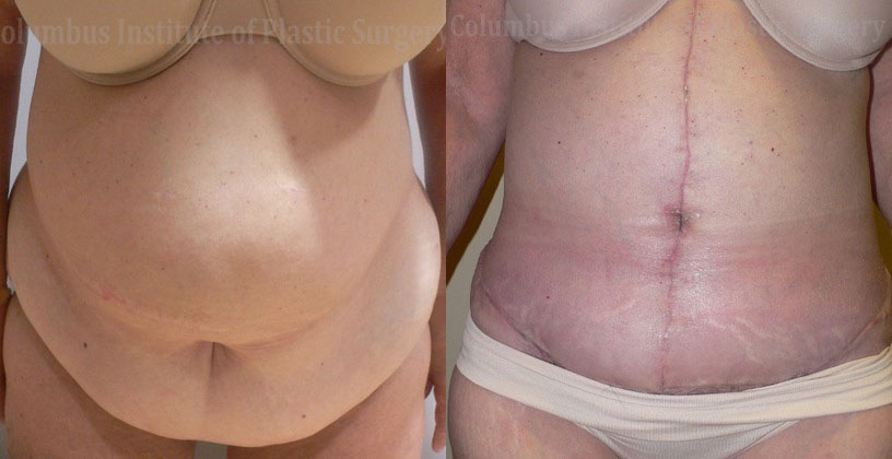 Abdominoplasty after Weight Loss before and after photo by Columbus Institute of Plastic Surgery in Columbus, OH