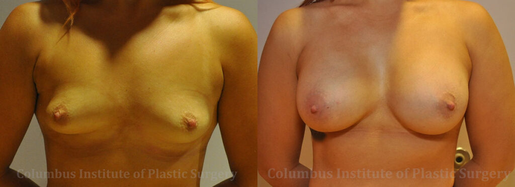 Breast Augmentation before and after photo by Columbus Institute of Plastic Surgery in Columbus, OH