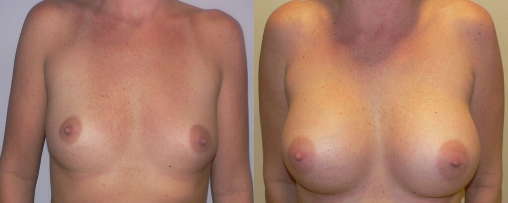 Breast Augmentation before and after photo by Columbus Institute of Plastic Surgery in Columbus, OH