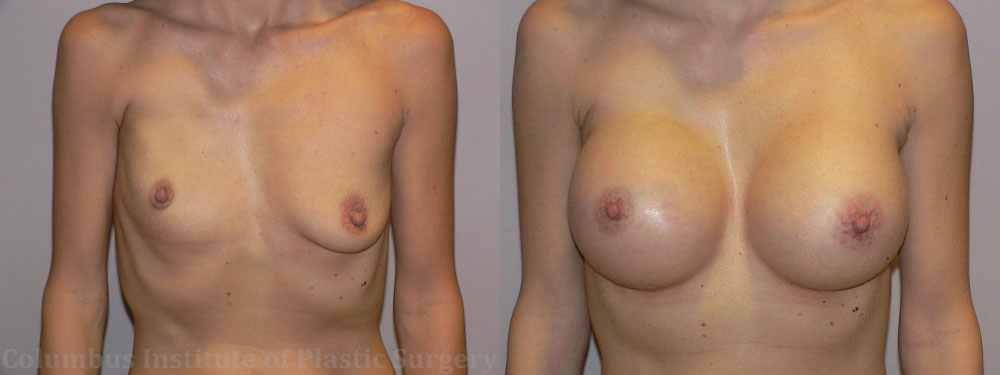 Breast Augmentation before and after photo by Columbus Institute of Plastic Surgery in Columbus, OH