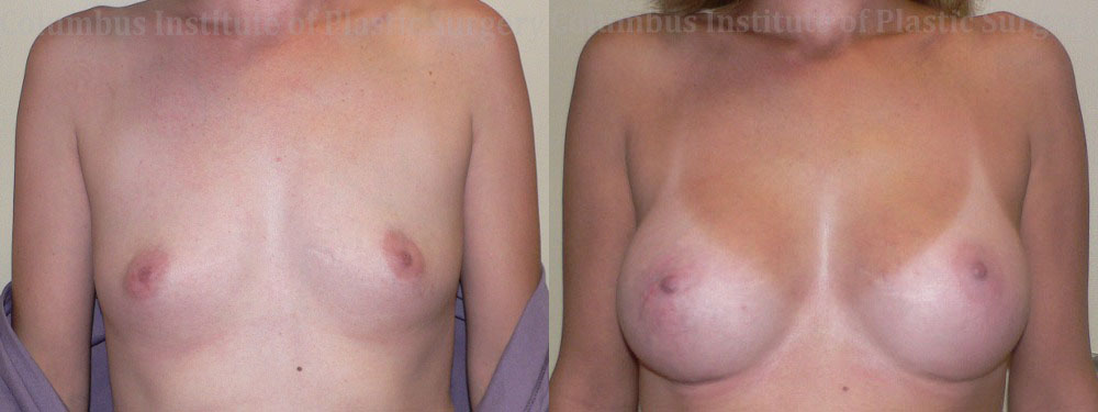 Breast Augmentation before and after photo by Columbus Institute of Plastic Surgery in Columbus, OH