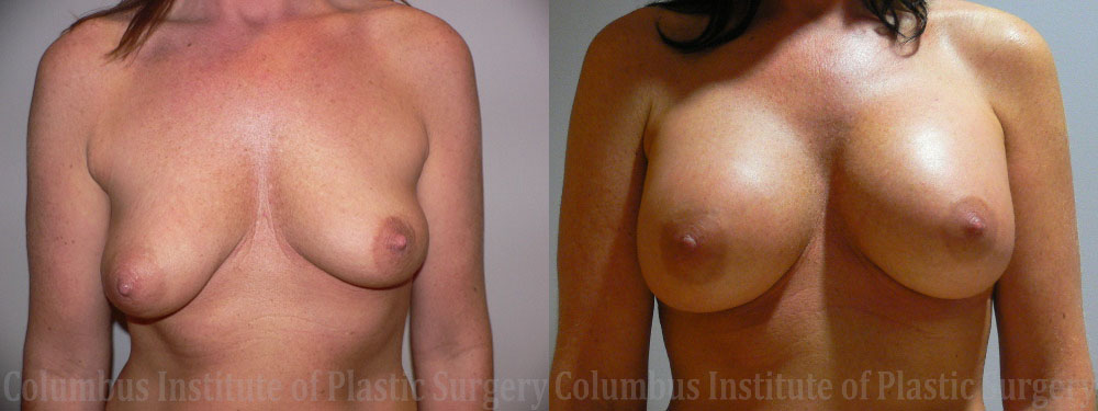 Breast Augmentation before and after photo by Columbus Institute of Plastic Surgery in Columbus, OH
