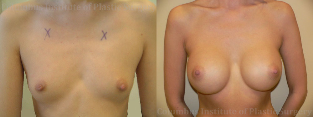 Breast Augmentation before and after photo by Columbus Institute of Plastic Surgery in Columbus, OH