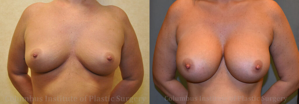 Breast Augmentation before and after photo by Columbus Institute of Plastic Surgery in Columbus, OH