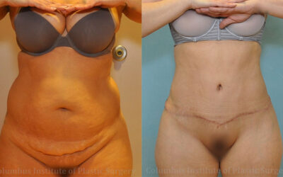 Abdominoplasty (Tummy Tuck) before and after photo by Columbus Institute of Plastic Surgery in Columbus, OH Abdominoplasty (Tummy Tuck) before and after photo by Columbus Institute of Plastic Surgery in Columbus, OH