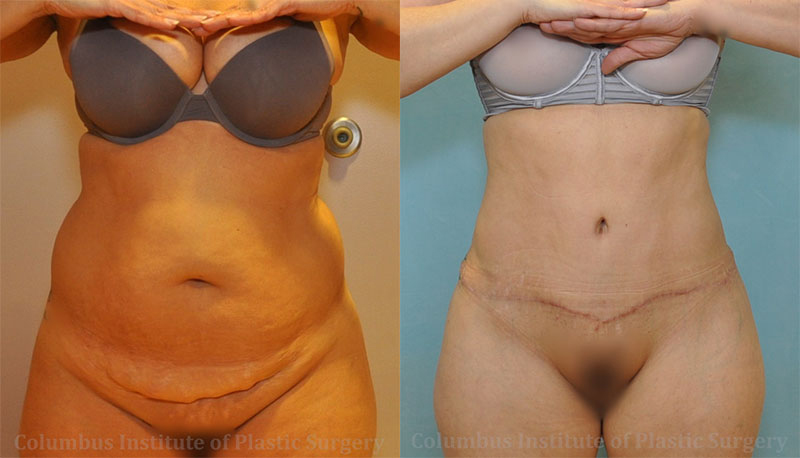 Abdominoplasty (Tummy Tuck) before and after photo by Columbus Institute of Plastic Surgery in Columbus, OH