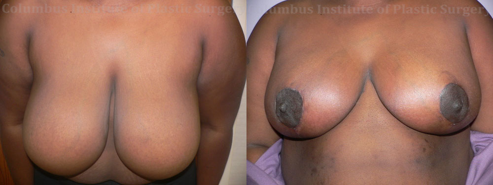 Breast Reduction before and after photo by Columbus Institute of Plastic Surgery in Columbus, OH