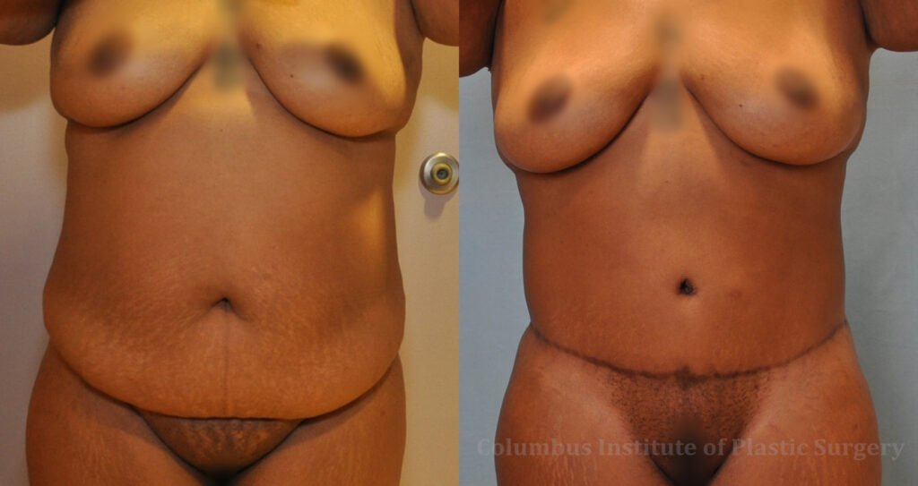 Liposuction before and after photo by Columbus Institute of Plastic Surgery in Columbus, OH