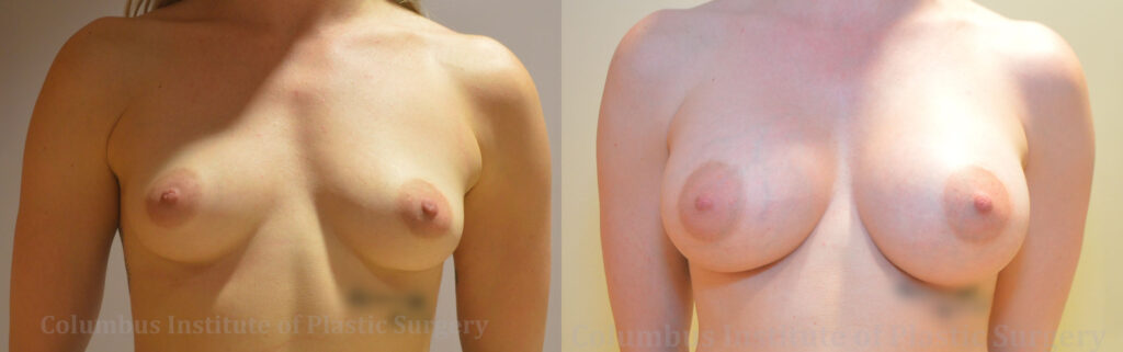 Breast Augmentation before and after photo by Columbus Institute of Plastic Surgery in Columbus, OH