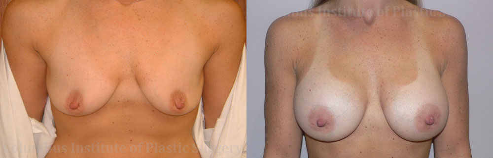 Breast Augmentation before and after photo by Columbus Institute of Plastic Surgery in Columbus, OH