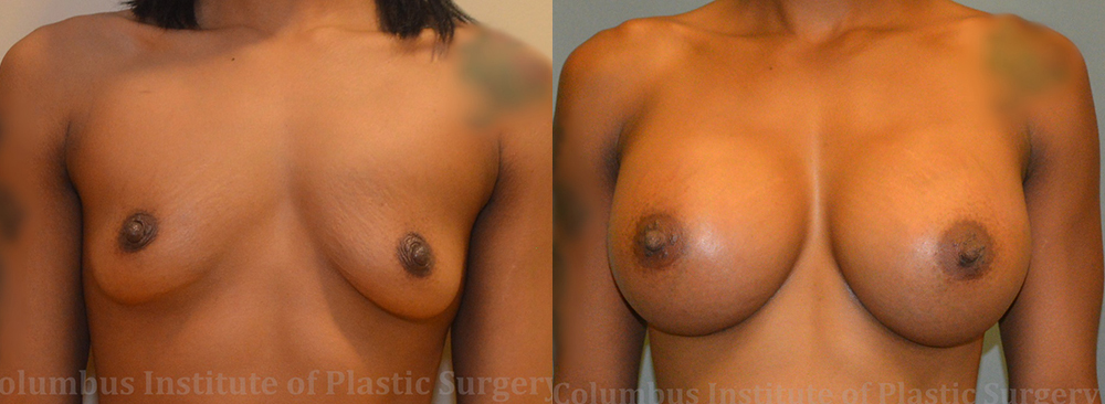 Breast Augmentation before and after photo by Columbus Institute of Plastic Surgery in Columbus, OH