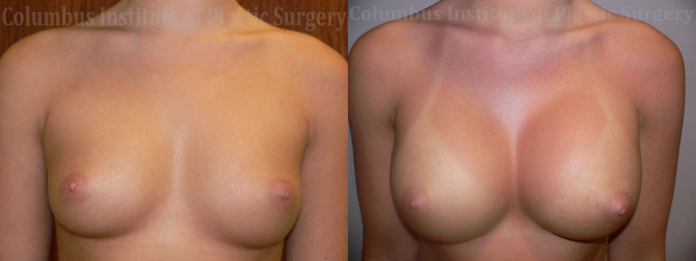 Breast Augmentation before and after photo by Columbus Institute of Plastic Surgery in Columbus, OH