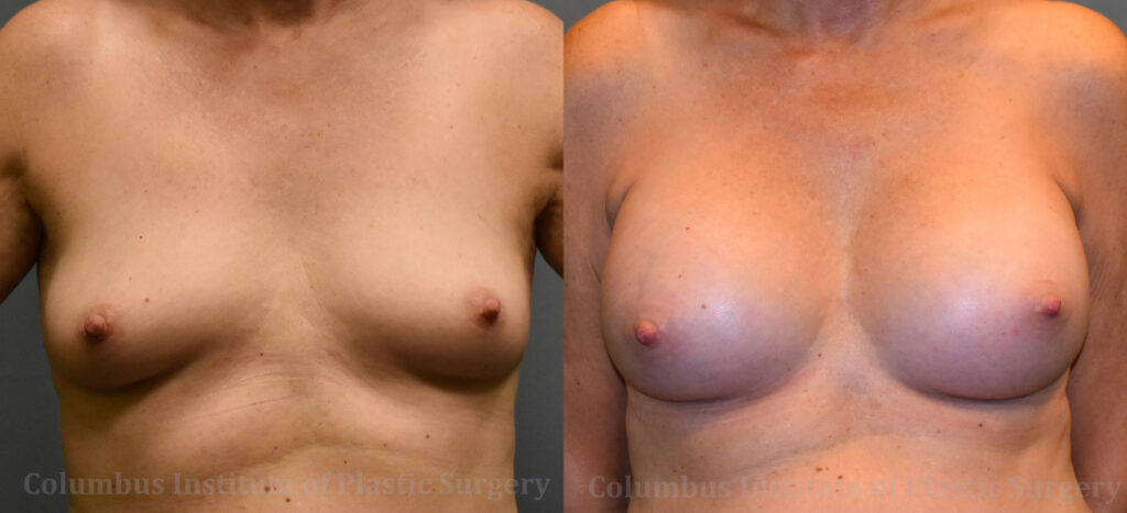 Breast Augmentation before and after photo by Columbus Institute of Plastic Surgery in Columbus, OH