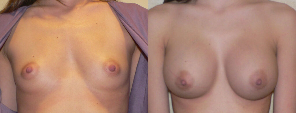 Breast Augmentation before and after photo by Columbus Institute of Plastic Surgery in Columbus, OH