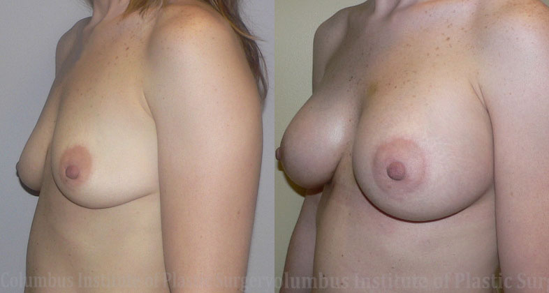 Breast Augmentation before and after photo by Columbus Institute of Plastic Surgery in Columbus, OH