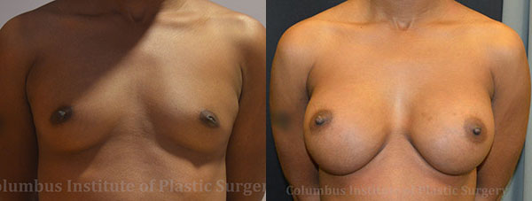 Breast Augmentation before and after photo by Columbus Institute of Plastic Surgery in Columbus, OH
