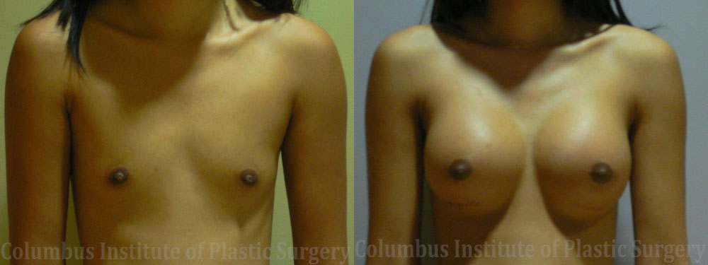 Breast Augmentation before and after photo by Columbus Institute of Plastic Surgery in Columbus, OH