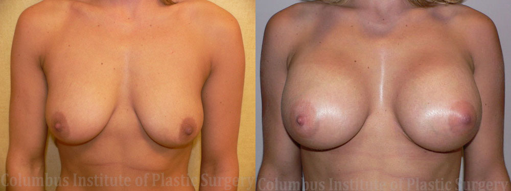Breast Augmentation before and after photo by Columbus Institute of Plastic Surgery in Columbus, OH
