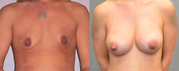 Breast Augmentation before and after photo by Columbus Institute of Plastic Surgery in Columbus, OH